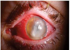 Bildet viser øye med endoftalmitt, som er en alvorlig infeksjon i øyet. Endoftalmitt er den komplikasjonen øyeleger frykter mest når de opererer, for eksempel grå stær. Risikoen for å bli blind er stor hvis pasienten ikke får rask behandling med antibiotika. Foto: Ragnheidur Bragadottir.