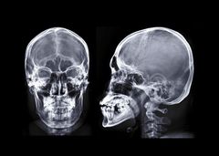 Røntgenbilde av hode