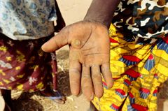 Hånden til en ung kvinne med vannblemmer etter hun knust hirse i landsbyen Iskita i Niger. Foto: cn1433/ILO/M. Crozet.