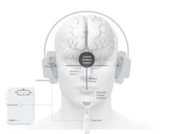 Lenire's bimodal neuromodulation provides stimulation to the tongue with sounds played through headphones