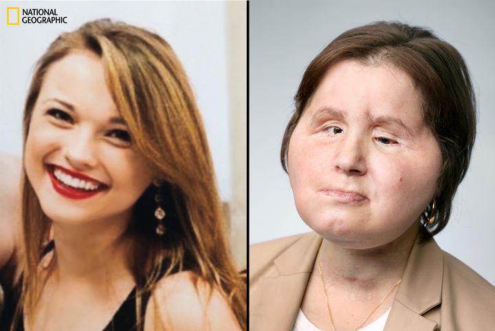 Til venstre: Katie Stubblefield, åtte måneder før selvmordforsøket. Til høyre: Cirka ett år etter operasjonen. Foto: Privat/Martin Schoeller.