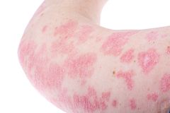 Slik kan plakkpsoriasis se ut (Illustrasjonsbilde)
