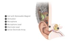 MED-EL Launches World's First Commercially Available Totally Invisible Cochlear Implant.  Copyright: MED-EL