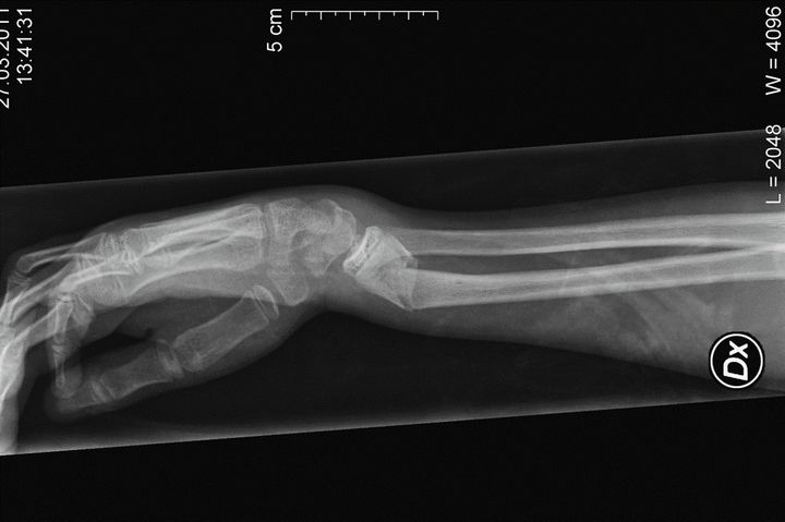 Røntgenbilde av et håndleddsbrudd, som er en vanlig skade i skibakken.