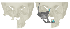 Modell som viser hodeskalle med manglende ansiktsdeler før og etter innsetting av implantat.