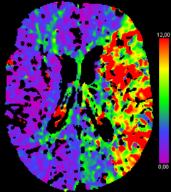 CT-bilete av en hjerne.