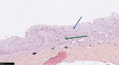 Biletet viser hud hos hunderørret med mistanke om ulcerativ dermal nekrose (UDN). I epidermis ser ein oppsvulne og degenerative epitelceller (blå pil) med subepidermal nekrose (grøn pil). Foto: Toni Erkinharju, Veterinærinstituttet.