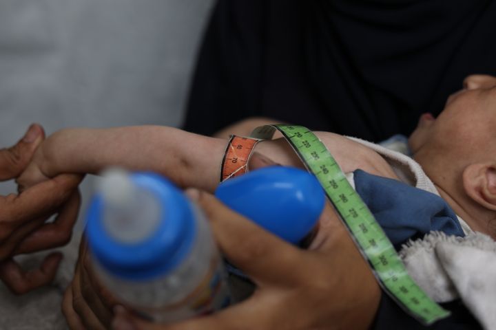 Et barn som lider av underernæring, blir undersøkt på Leger Uten Grensers klinikk i Gaza by i juni.