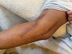 Tydelig bevis på skaden