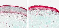 Bildene viser printet hud. Til venstre ser vi normal hud (uten betennelse) og bildet til høyre viser hvordan hud ser ut når det er betennelse (psoriasis).