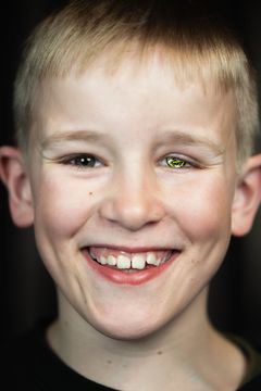 GLIMT I ØYET: Fredrik nøyer seg ikke med fotballdrakt: Øyeprotesen viser favorittlagets logo. Fredrik ble blind etter øyekreft som liten, og var blant barna som opplevde massiv støtte fra hele Norge på FotballtrøyeFredag.